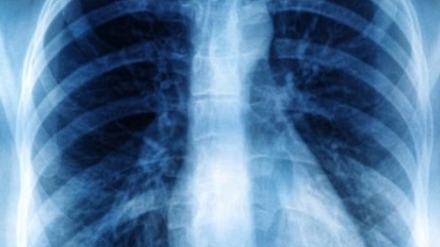 Radiografie pulmonară