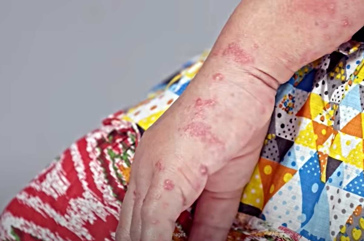 Nou caz de variola maimuței diagnosticat în România